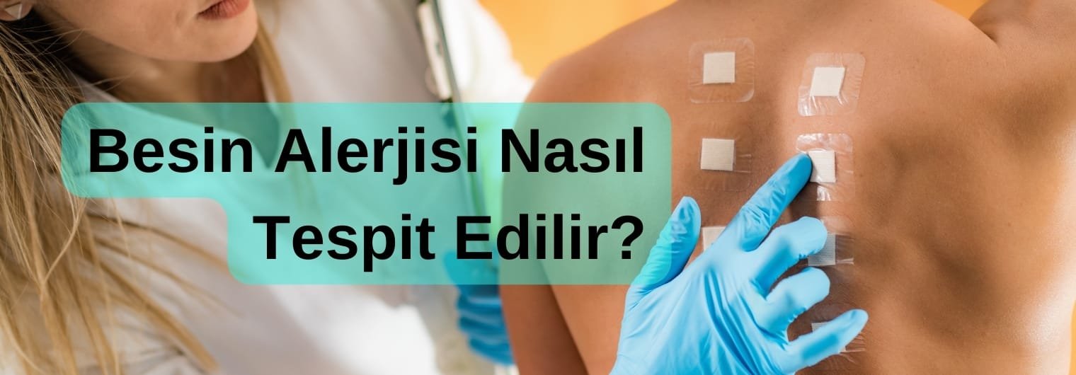 Besin Alerjisi Nasıl Tespit Edilir